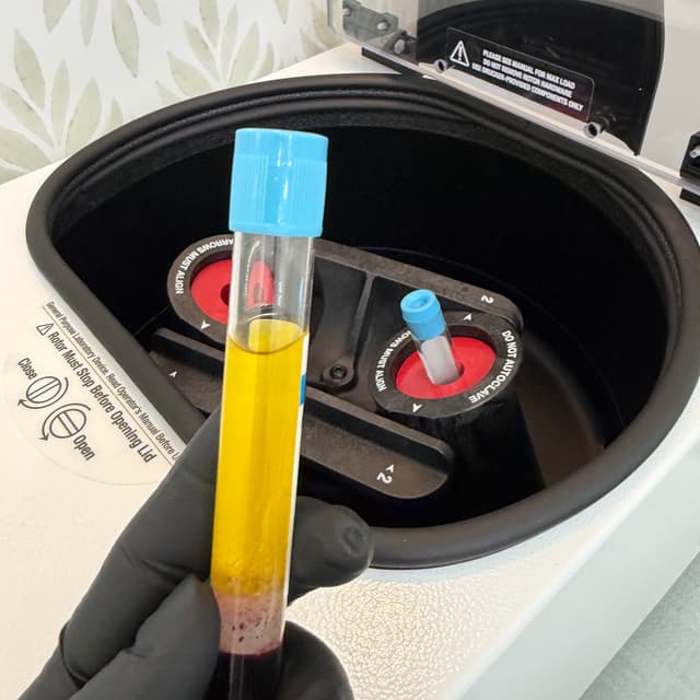 PRP-Enhanced Skin Rejuvenation at Glowtox Spa in Sola Salon in Orland Park, IL